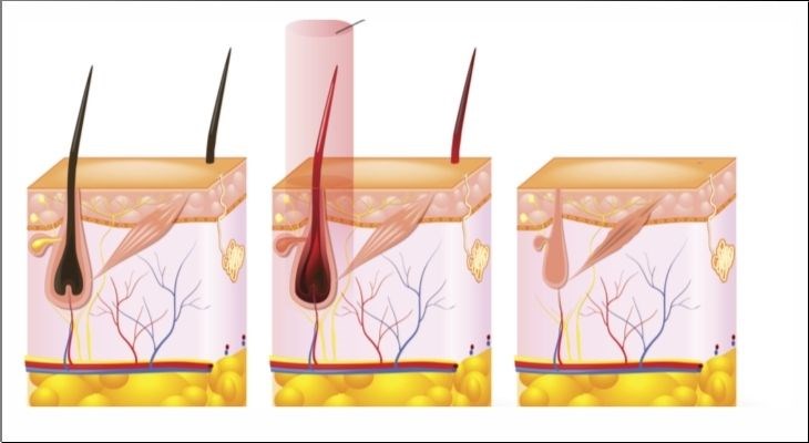 Công nghệ ipl: giải pháp làm đẹp hiệu quả cho làn da
